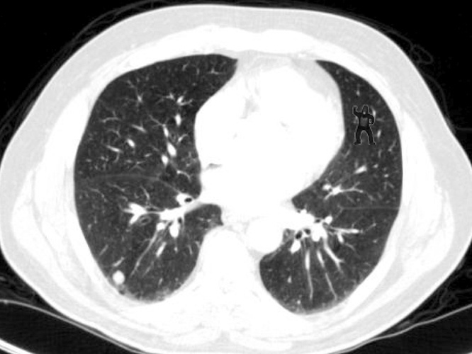 Why Even Radiologists Can Miss A Gorilla Hiding In Plain Sight